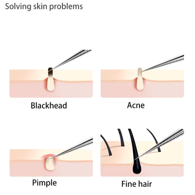Acne Blackhead Removal Needles