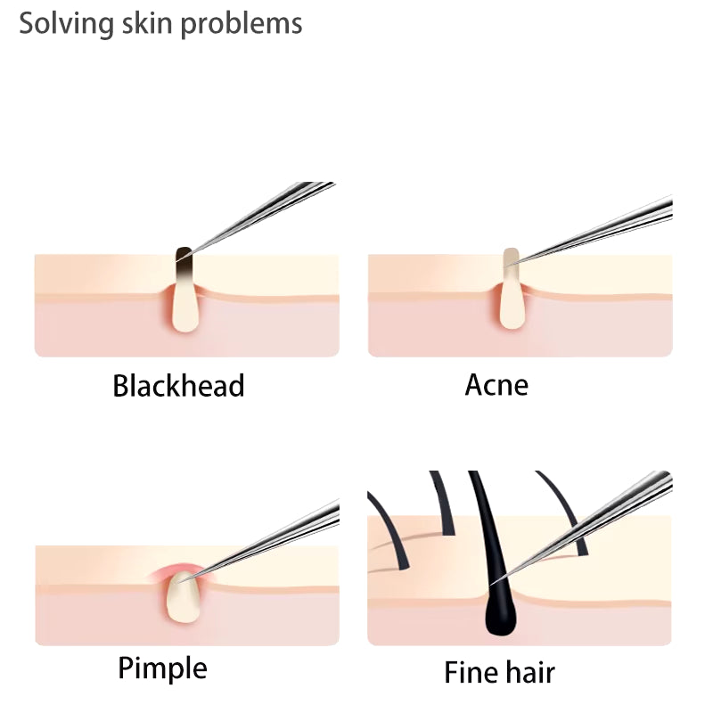 Acne Blackhead Removal Needles