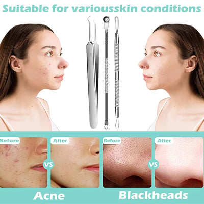 Acne Blackhead Removal Needles